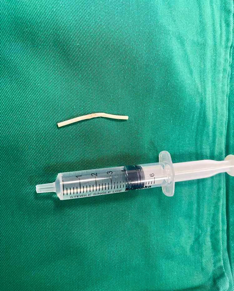 Que tránh thai được lấy ra thành công - Ảnh BVCC