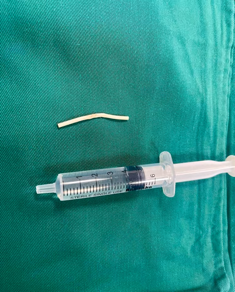 Que tránh thai được lấy ra thành công - Ảnh BVCC