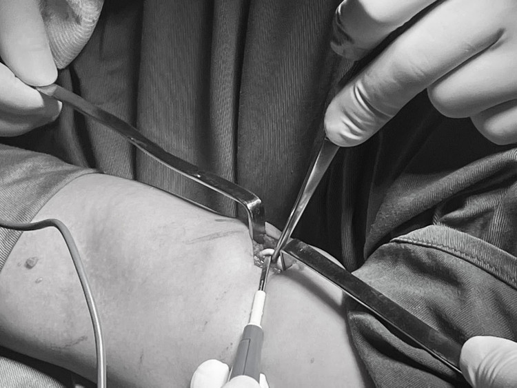 Que tránh thai ở sâu trong cơ cánh tay - Ảnh BVCC