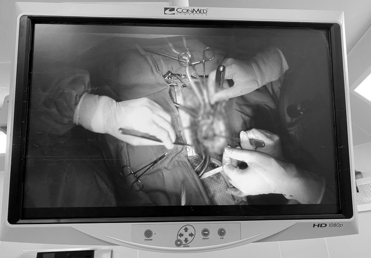 Bệnh nhân được các phẫu thuật viên thực hiện sửa van tim -Ảnh BVCC