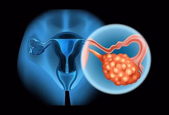 Hội chứng buồng trứng đa nang làm tăng nguy cơ cao huyết áp - Ảnh BSCC