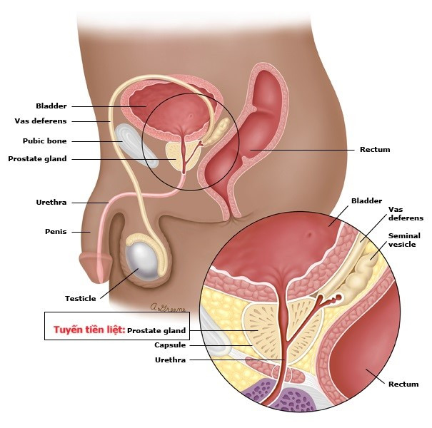 Ung thư tuyến tiền liệt - Ảnh BVCC