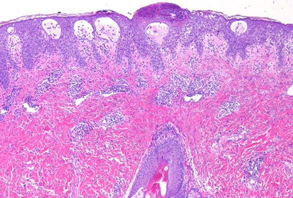 Hình ảnh tổn thương lâm sàng của AGEP (Nguồn: Internet)