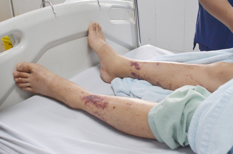 Nổi vân tím toàn thân, xuất huyết dưới da rải rác.