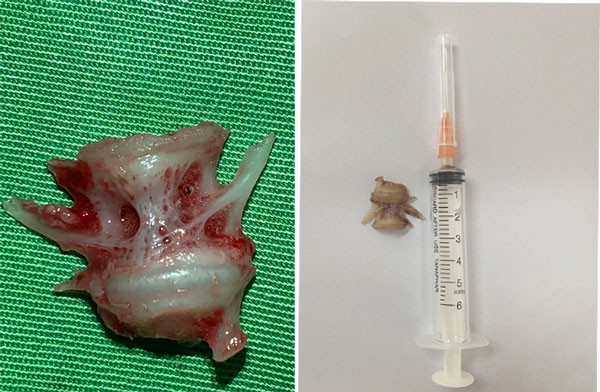 Gắp mảnh xương cá lớn cắm sâu trong thực quản người bệnh ảnh 1