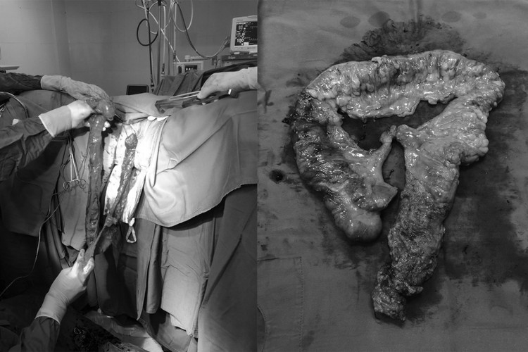 Hình ảnh khối ung thư của bệnh nhân