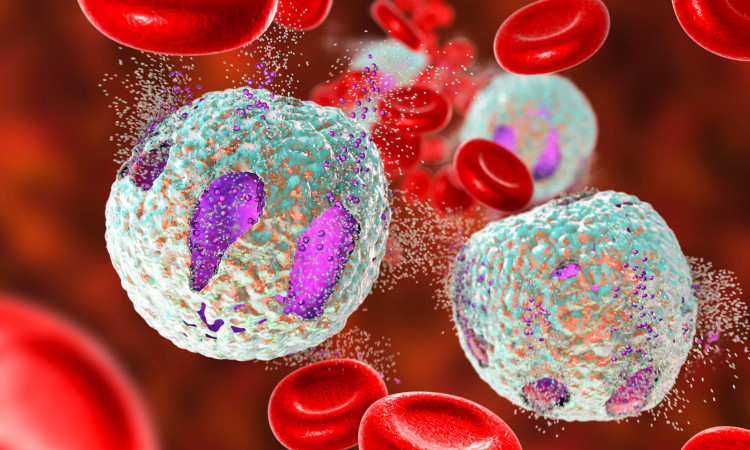 Mệt mỏi, ra mồ hôi...cẩn thận mắc ung thư máu ác tính: Lơ xê mi kinh dòng bạch cầu hạt