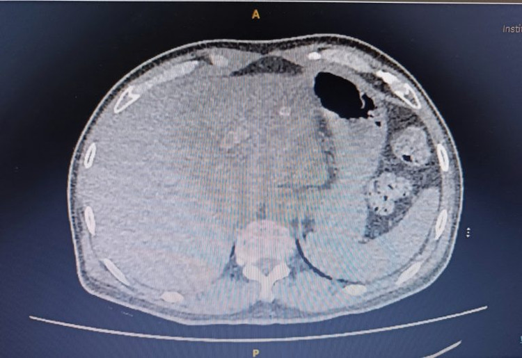 Hình ảnh CT ổ bụng thấy khối thoát vị thành bụng - Ảnh BVCC