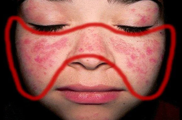 Hồng ban có dạng hình cánh bướm ở mặt là một dấu hiệu rất đặc trưng của lupus ban đỏ