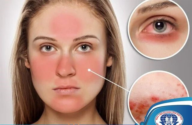 Bác sĩ chỉ cách chung sống với bệnh lupus ban đỏ - Ảnh BVCC