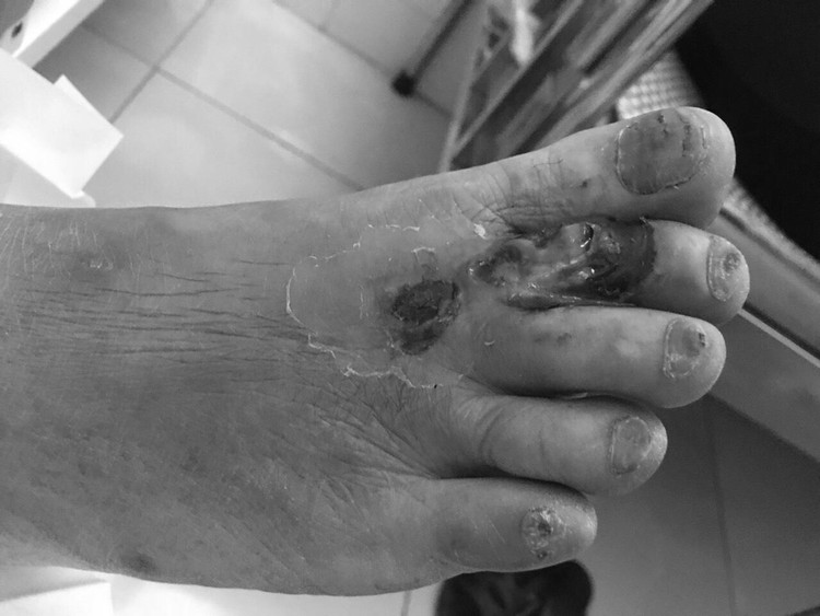 Hình ảnh chân tổn thương ở người bệnh đái tháo đường