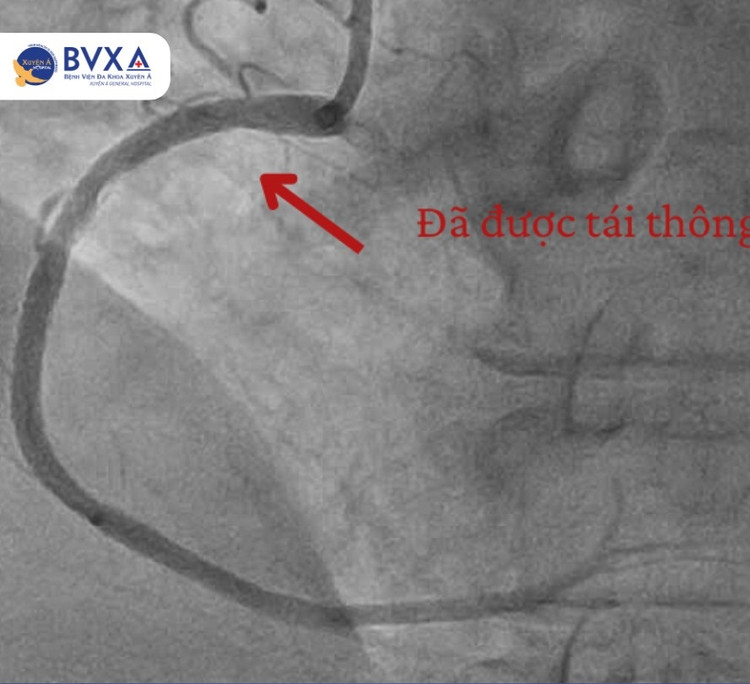 Đang sinh hoạt tại nhà, người phụ nữ 60 tuổi sốc tim nguy kịch ảnh 2