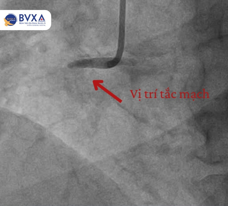 Đang sinh hoạt tại nhà, người phụ nữ 60 tuổi sốc tim nguy kịch ảnh 1