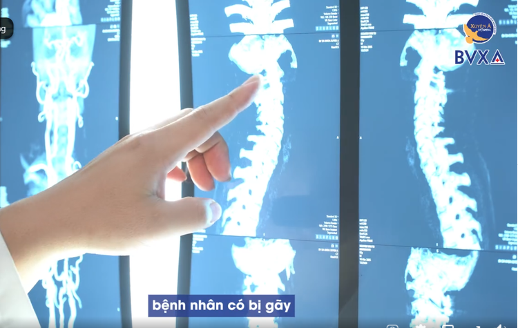 Hình ảnh cột sống cổ bị gẫy trên phim chụp - Ảnh BVCC