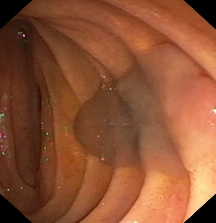 Hình ảnh sán lá gan trong quá trình nội soi - Ảnh BVCC