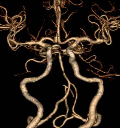 Hình ảnh hẹp động mạch thân nền của bệnh nhân P.T.N