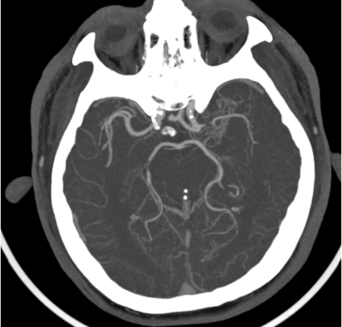 Hình ảnh hẹp động mạch não giữa trái đoạn M1 của bệnh nhân N.V.Đ - Ảnh BVCC