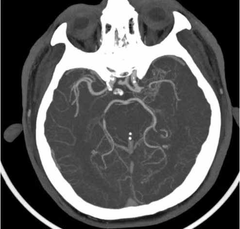 Hình ảnh hẹp động mạch não giữa trái đoạn M1 của bệnh nhân N.V.Đ - Ảnh BVCC