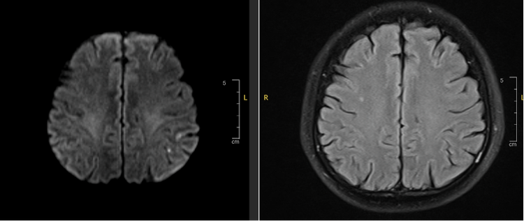 Hình ảnh Mismatch trên xung DWI và FLAIR của bệnh nhân N.V.Đ - Ảnh BVCC