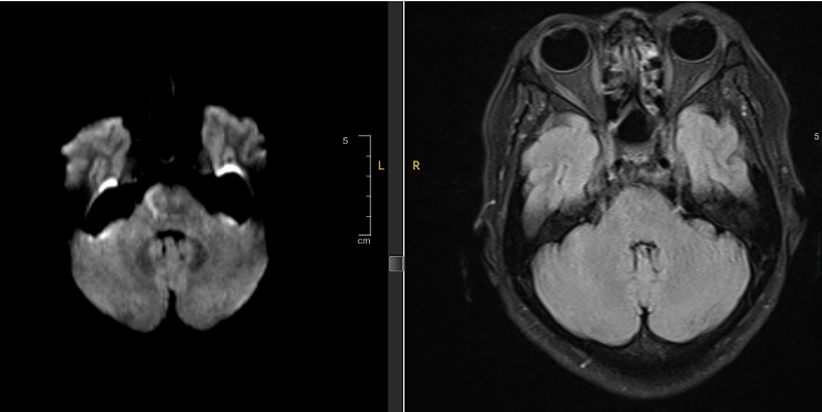 Hình ảnh Mismatch trên xung DWI và FLAIR của bệnh nhân P.T.N - Ảnh BVCC