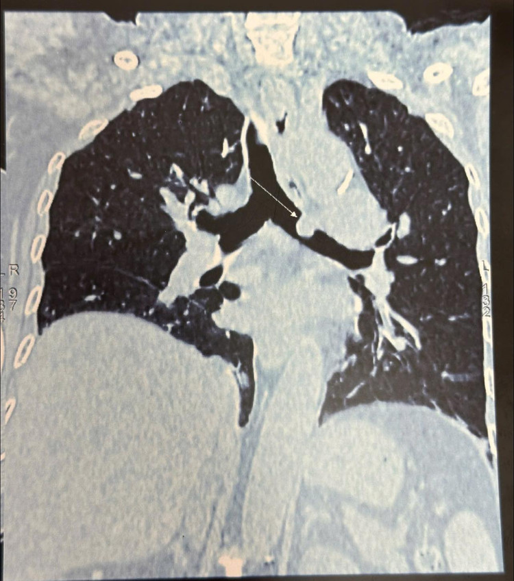 Tốn thương ung thư phổi trên phim chụp - Ảnh BVCC