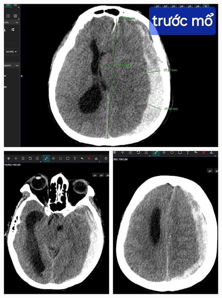 Cứu sống bệnh nhân bị tai nạn chấn thương sọ não, tiên lượng rất nặng ảnh 1 Cứu sống bệnh nhân bị tai nạn chấn thương sọ não, tiên lượng rất nặng ảnh 1