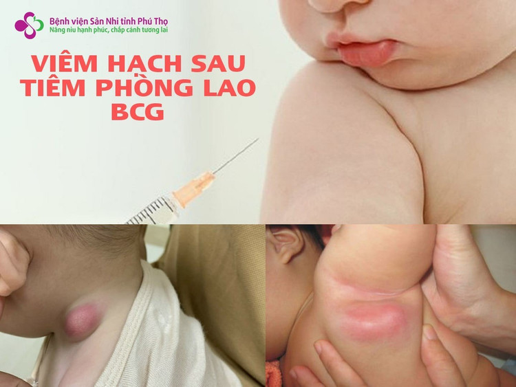 Bác sĩ chỉ cách xử trí viêm hạch sau tiêm phòng vắc xin lao ảnh 1