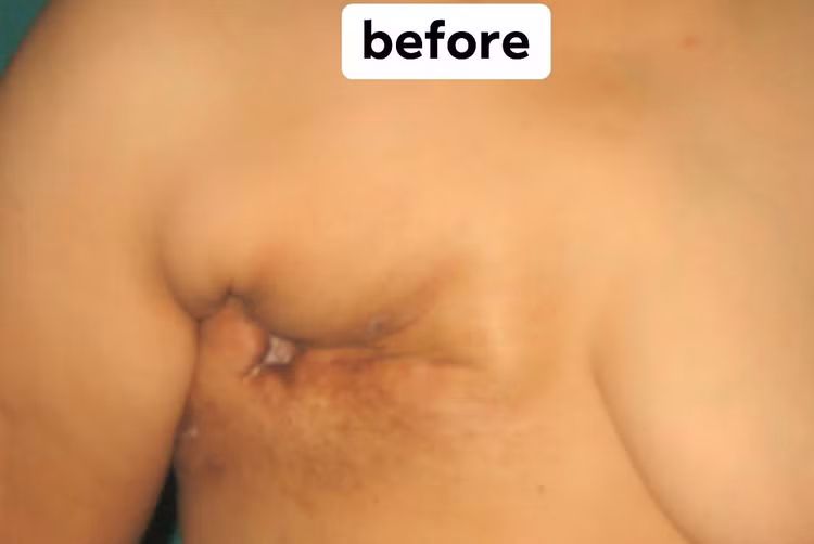 Tái tạo ngực sau ung thư giảm biến chứng loét sau xạ trị ảnh 1