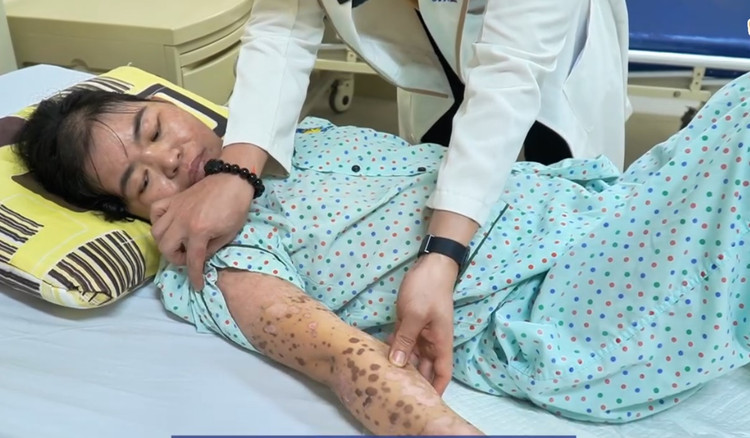 Các tổn thương trên da của bệnh nhân đang hồi phục - Ảnh BVCC