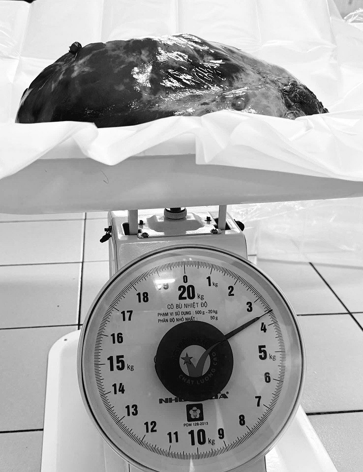 Khối u có kích thước 30x20 cm, nặng 3,6 kg, xâm chiếm gần như toàn bộ khoang ngực của bệnh nhân - Ảnh BVCC