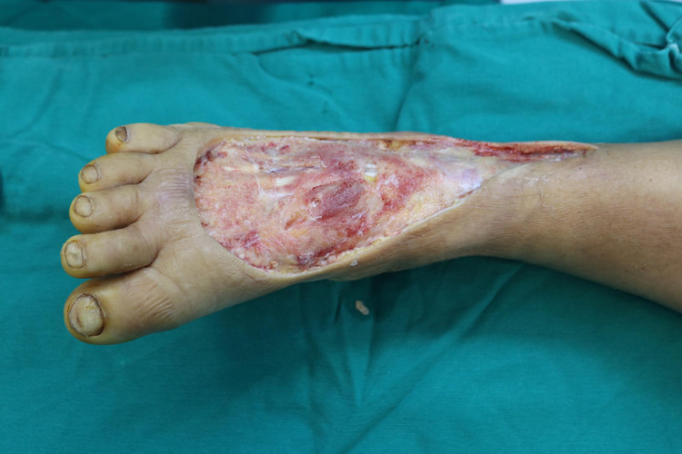 Ghép da: Chi phí phẫu thuật, thực hiện ở đâu an toàn, hiệu quả? ảnh 1