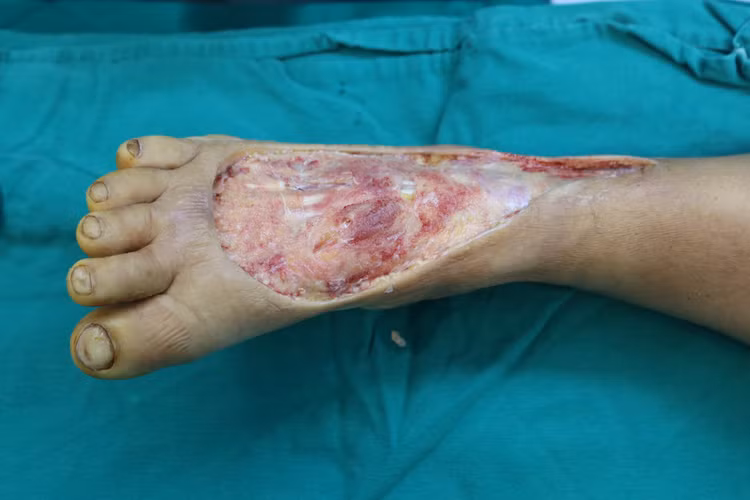 Ghép da: Chi phí phẫu thuật, thực hiện ở đâu an toàn, hiệu quả? ảnh 1