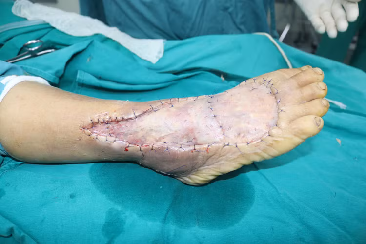 Ghép da: Chi phí phẫu thuật, thực hiện ở đâu an toàn, hiệu quả? ảnh 2