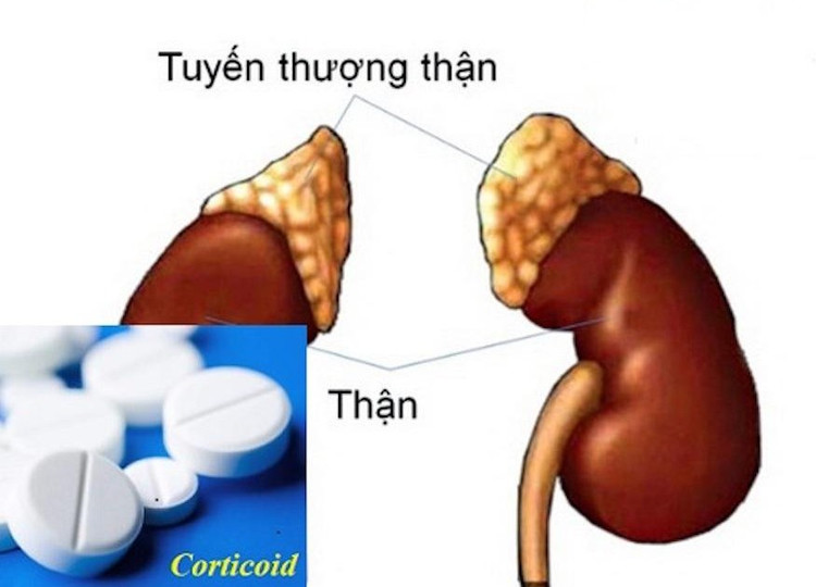 Suy thượng thận do thuốc Corticoid - ảnh minh họa