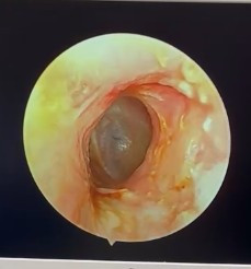 Ống tai sau phẫu thuật - Màng tai được nhìn thấy rõ dưới nội soi Ống tai sau phẫu thuật - Màng tai được nhìn thấy rõ dưới nội soi