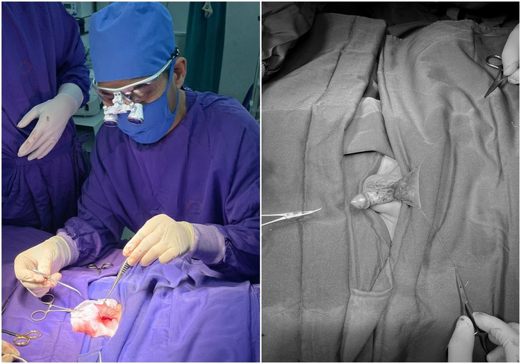 Điều trị lỗ tiểu thấp sớm, tránh nguy cơ vô sinh cho trẻ trai ảnh 1