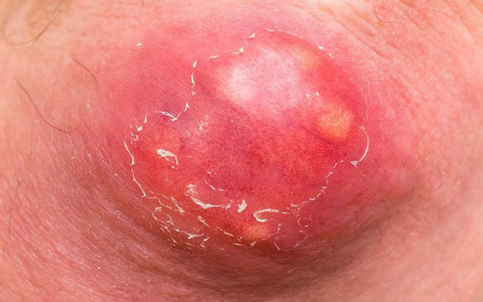 Cách xử lý mụn nhọt, tránh nhiễm trùng nguy hiểm - Ảnh minh họa Cách xử lý mụn nhọt, tránh nhiễm trùng nguy hiểm - Ảnh minh họa