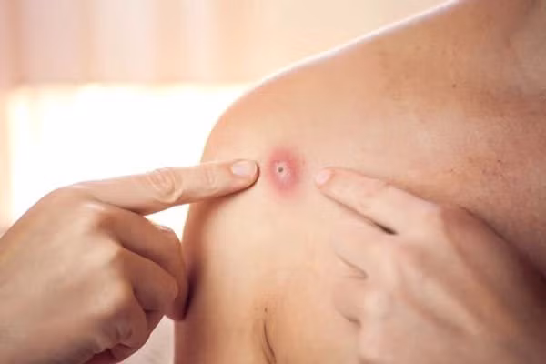 Bộ Y tế: Báo cáo kịp thời trường hợp nghi ngờ, mắc bệnh đậu mùa khỉ ảnh 1