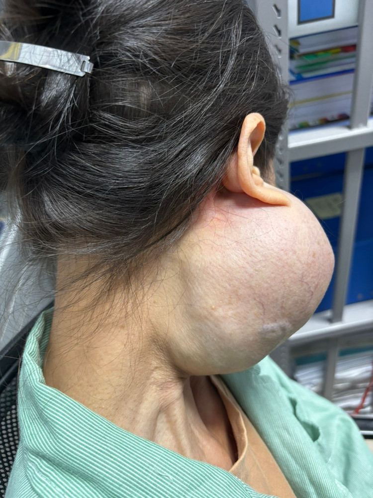 Suýt mất mạng vì 14 năm không điều trị u “khổng lồ” trên mặt - Ảnh BVCC