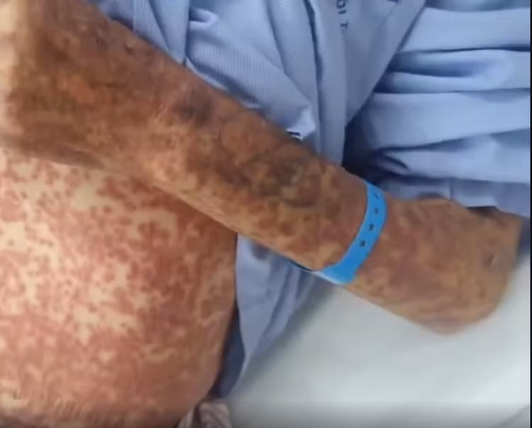 Bệnh nhân dị ứng toàn thân do thuốc - Ảnh BVCC