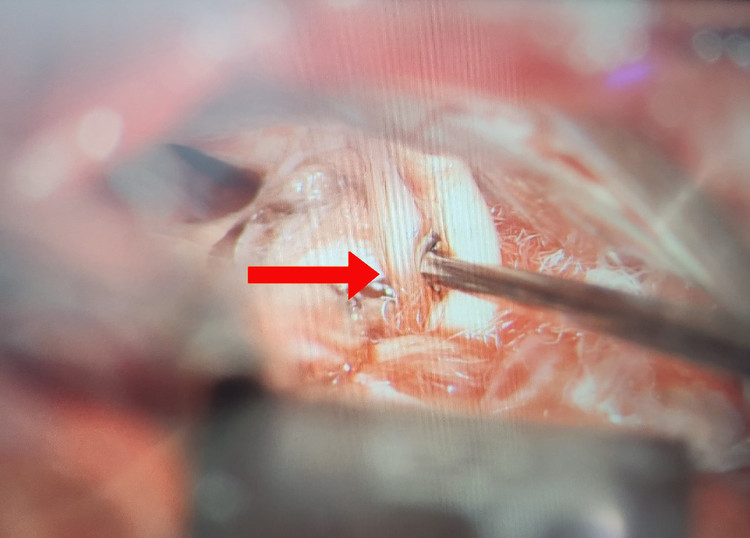 Hình ảnh dây thần kinh số VII sau khi được giải ép - Ảnh: BVCC