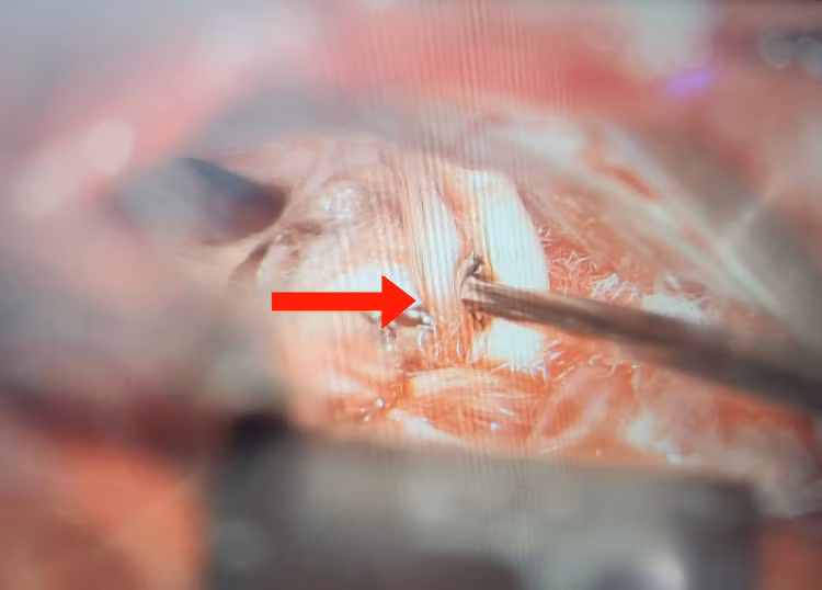 Hình ảnh dây thần kinh số VII sau khi được giải ép - Ảnh: BVCC