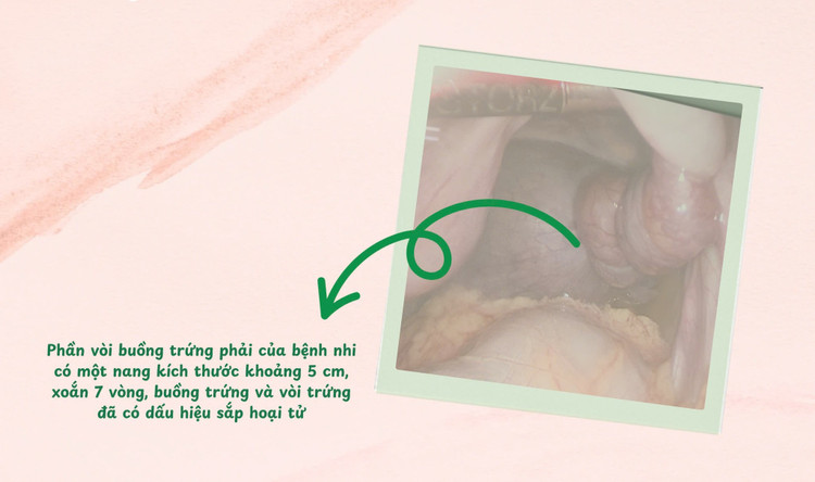 Vòi trứng xoắn - Ảnh BVCC