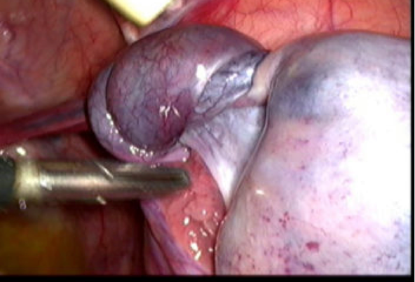 Vòi trứng, buồng trứng hoại tử do phát hiện muộn - Ảnh BVCC