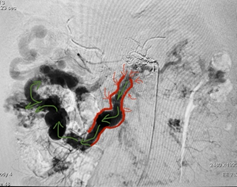Hình đoạn ruột bệnh - Ảnh BVCC