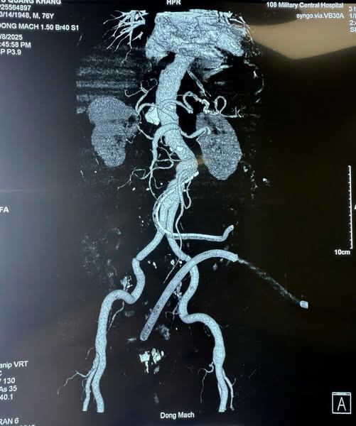 Phim chụp CT sau mổ - Ảnh BSCC