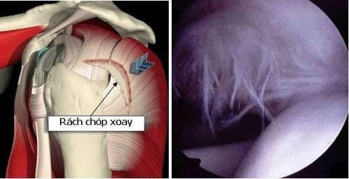 Chóp xoay có thể bị rách ở bất cứ vị trí nào, nhưng thường nhất là rách cơ trên gai