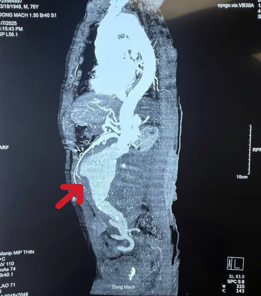 Phim chụp CT trước phẫu thuật cho thấy điểm vỡ và thấm máu xung quanh khối phình - Ảnh BSCC