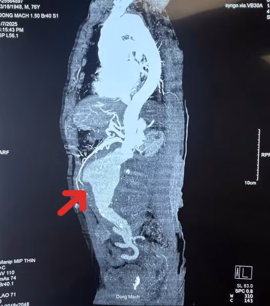 Phim chụp CT trước phẫu thuật cho thấy điểm vỡ và thấm máu xung quanh khối phình - Ảnh BSCC