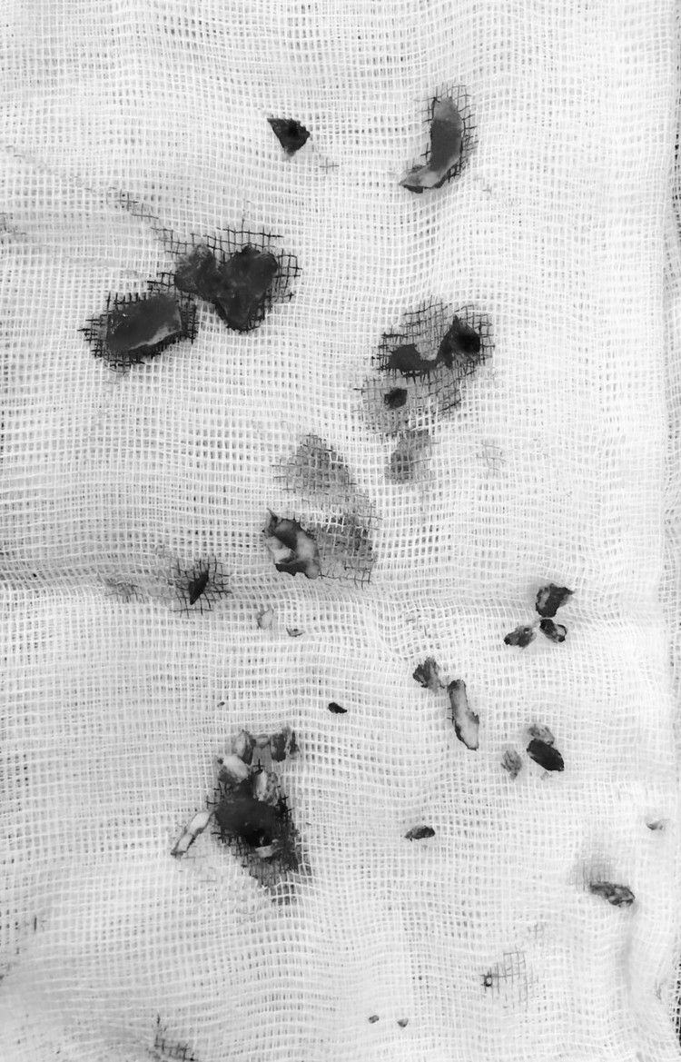 Các mảnh xương sọ và nhu mô não dập được mổ lấy ra - Ảnh BVCC